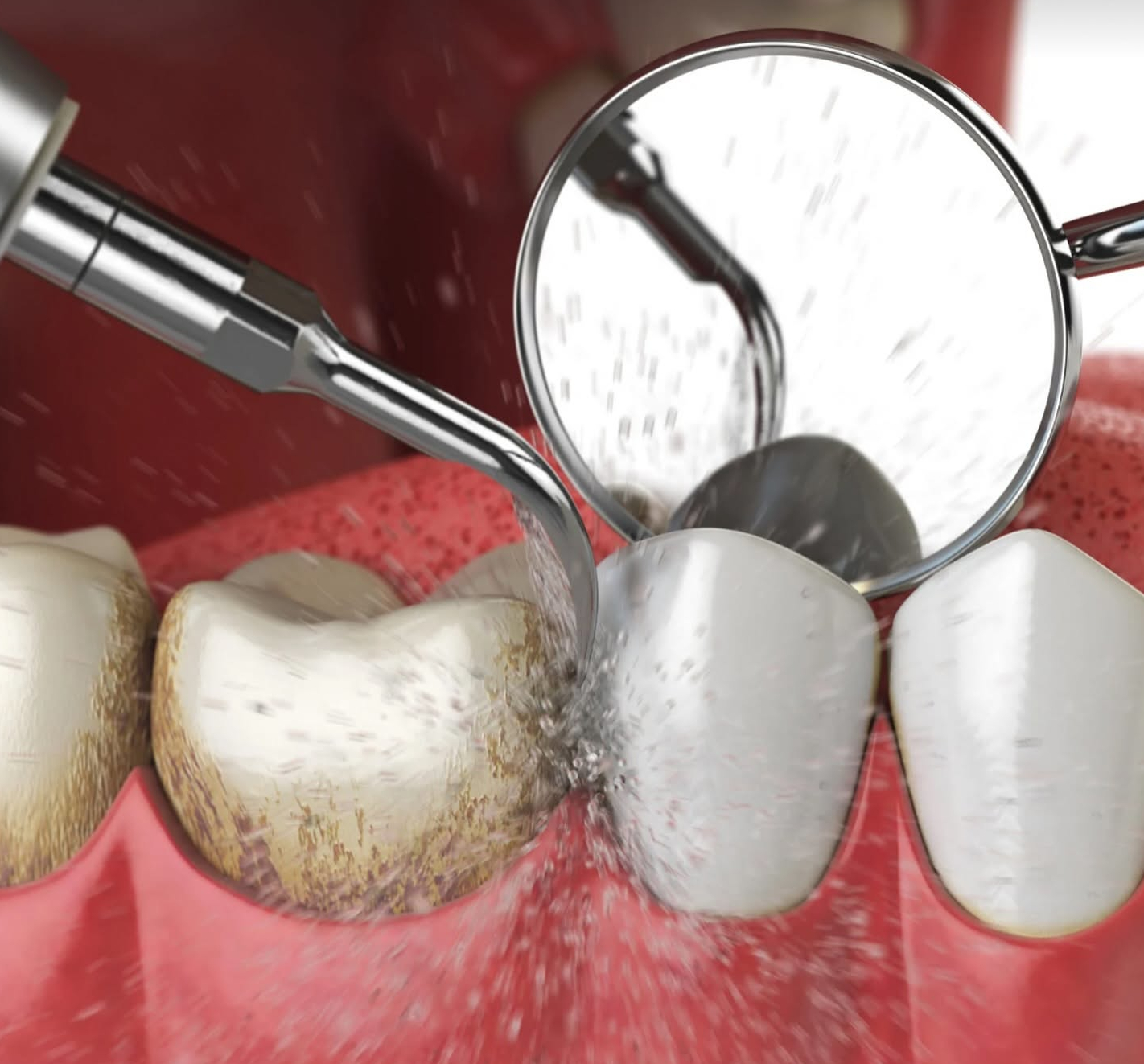 Paciente durante procedimento de limpeza dental
